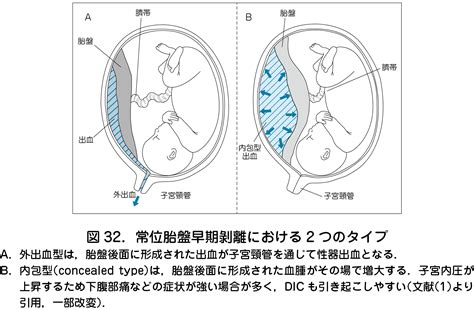 胎盤剝離後期|胎盤がはがれる、常位胎盤早期剥離について｜東京・世田谷での 